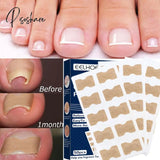 50Pc Waterproof Nail Correction Stickers Ingrown Toenail Corrector Patches Paronychia Treatment