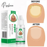 Nail Fungus Treat Onychomycosis Toe Feet Care Repair Anti Infections Paronychia Nails Skin